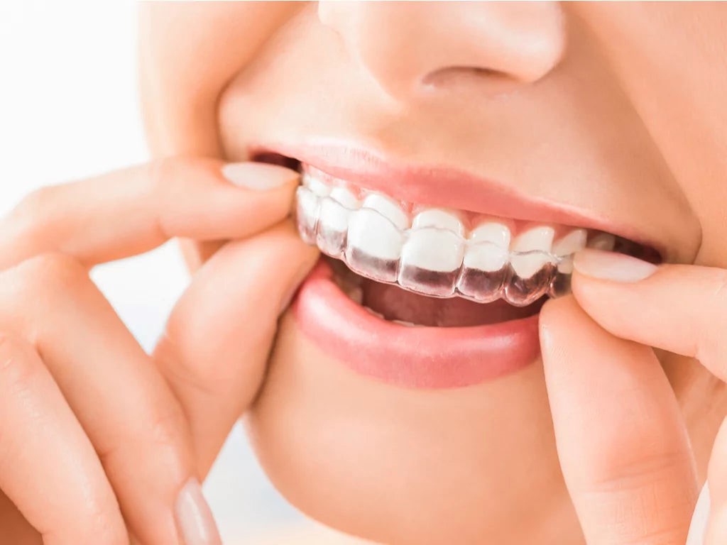 How Much Do Essix Retainer Cost In UK