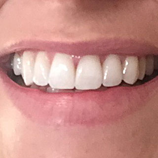 After Teeth